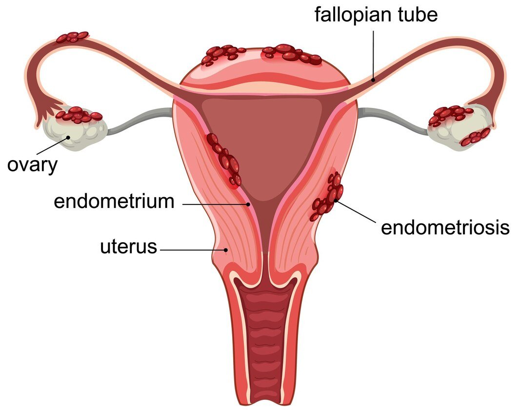 Illustration of uterus showing endometriosis affecting ovaries, fallopian tubes, and endometrium